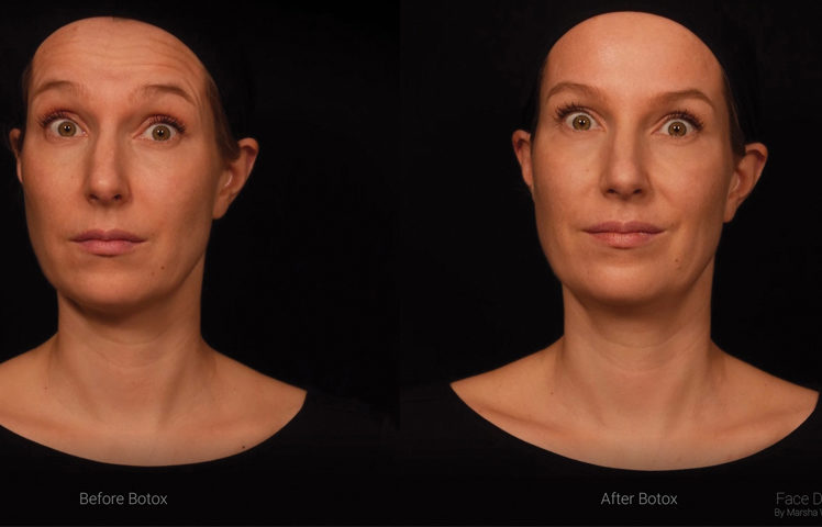 Como o Botóx afeta a expressão facial
